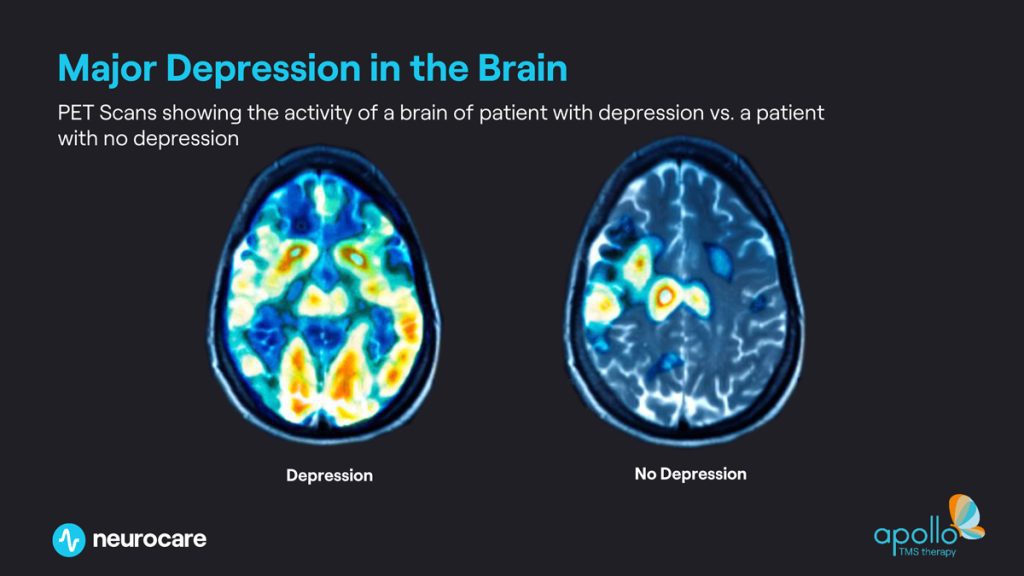 before-and-after-tms-treatment-1024x576-1